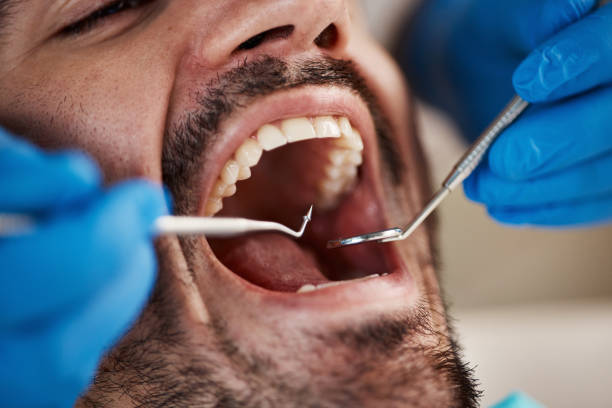 Best Emergency Wisdom Teeth Removal in Union City, PA