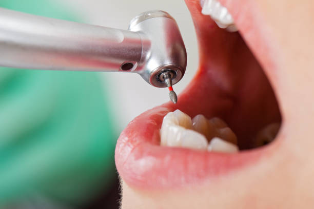 Best Emergency Treatment for Dental Infections or Abscesses in Union City, PA